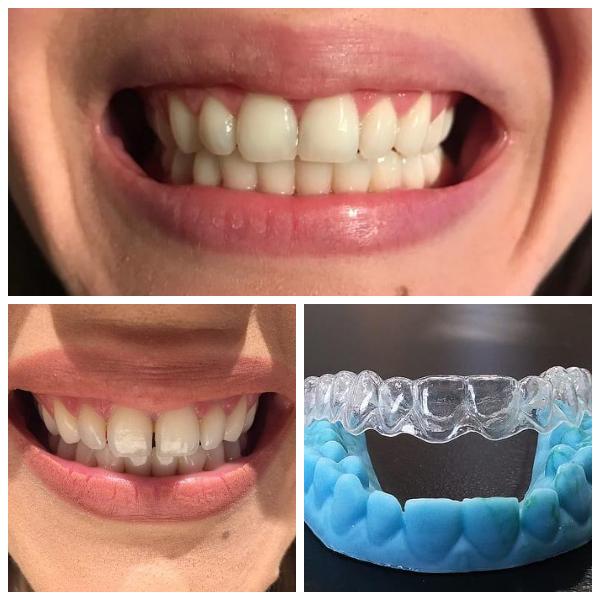 Smile aligners, invisible orthodontics. Painless centrals gap closure