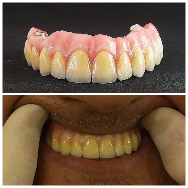 Full upper arch restoration. Metal ceramic prosthetics cemented on 4 Branemark implants. Natural teeth emergence due to layering technique and soft tissue configuration.