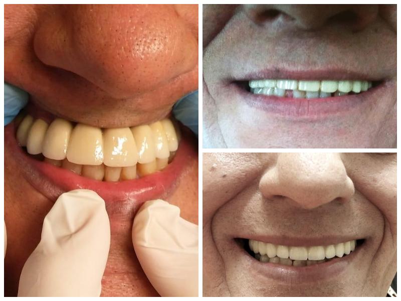 Full upper arch restoration. Metal ceramic prosthetics cemented on 4 Branemark implants. Correction of shape and teeth sise as well as the face midline.