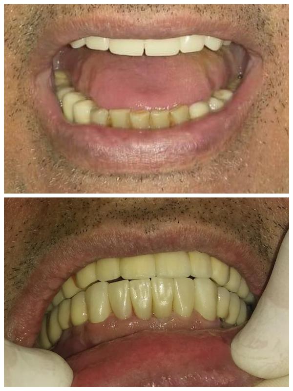 Μονολιθικές στεφάνες ζιρκονίας στα πρόσθια έξι δόντια κάτω γνάθου