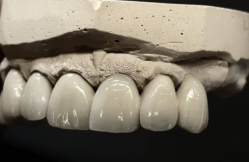 Fixed bridge consisted of metal framework and Composite materials for permanent restorations.