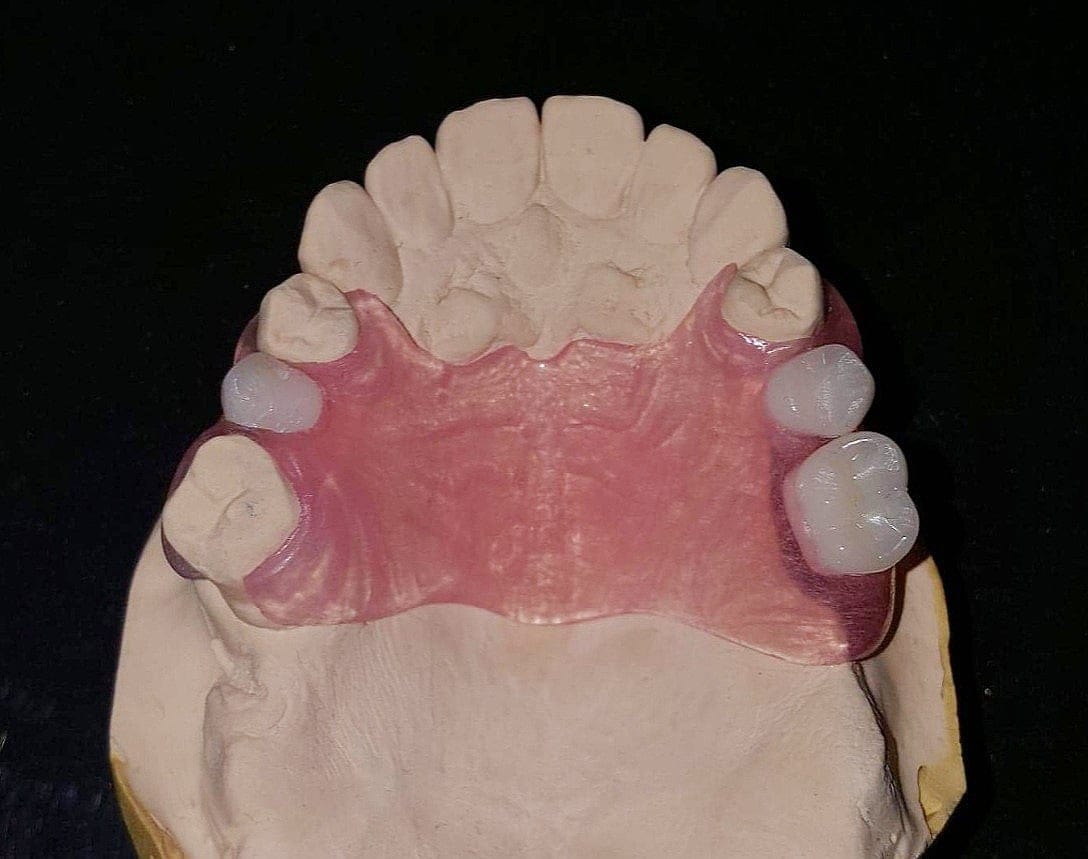 Partial thermoplastic denture