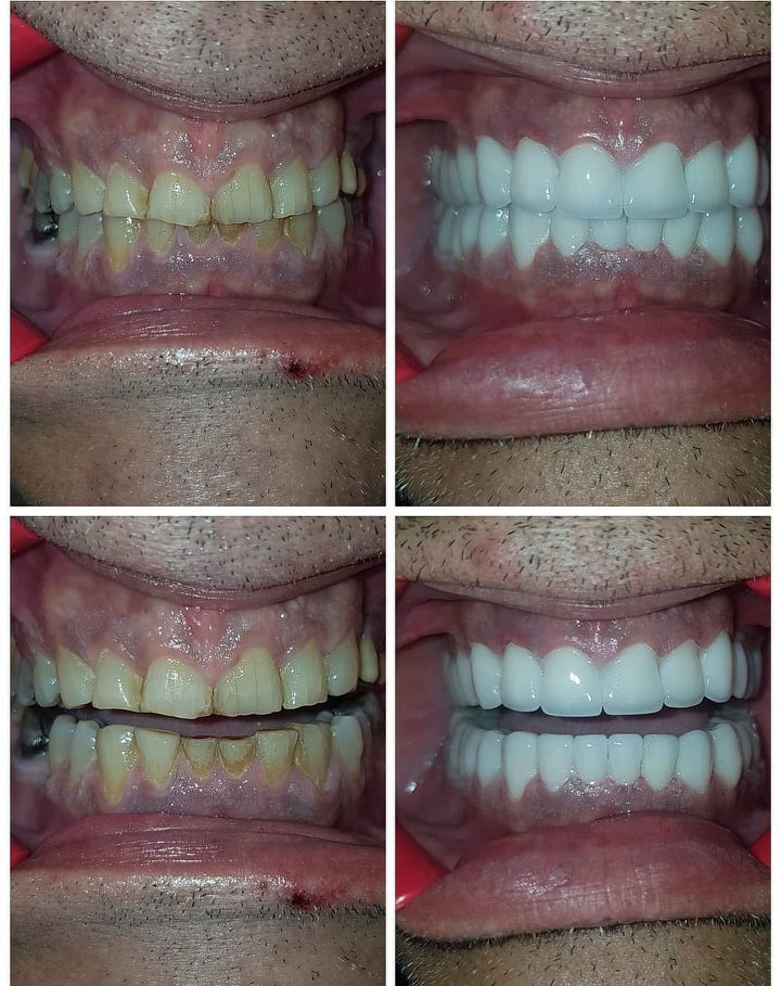 Full mouth restoration with zircon crown and bridges. Right after cementation.