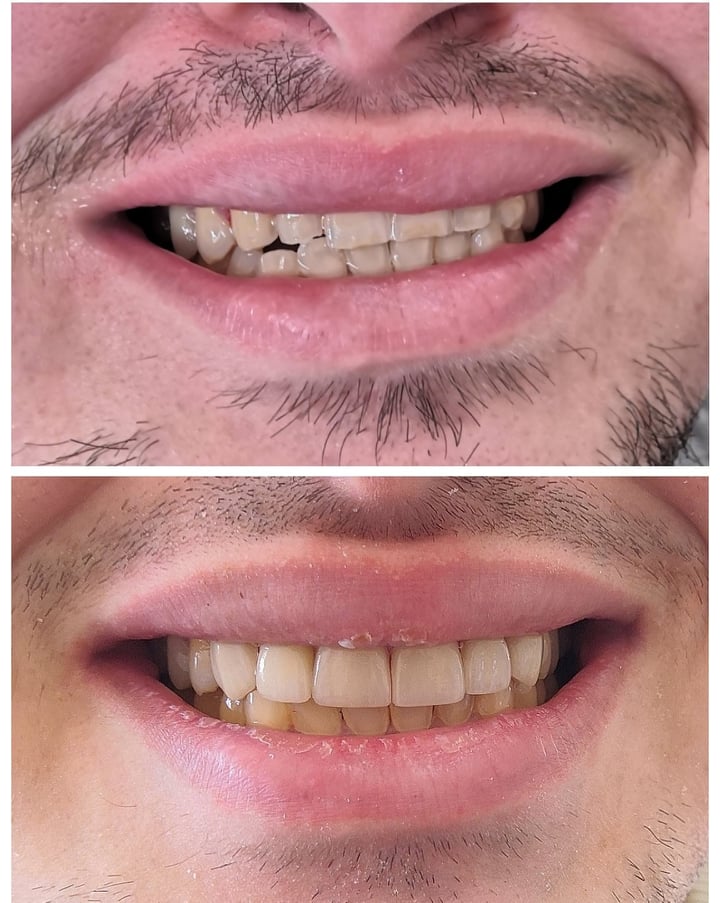 6 ολοκεραμικές όψεις σε πόροσθια δόντια με διαβρώσεις.