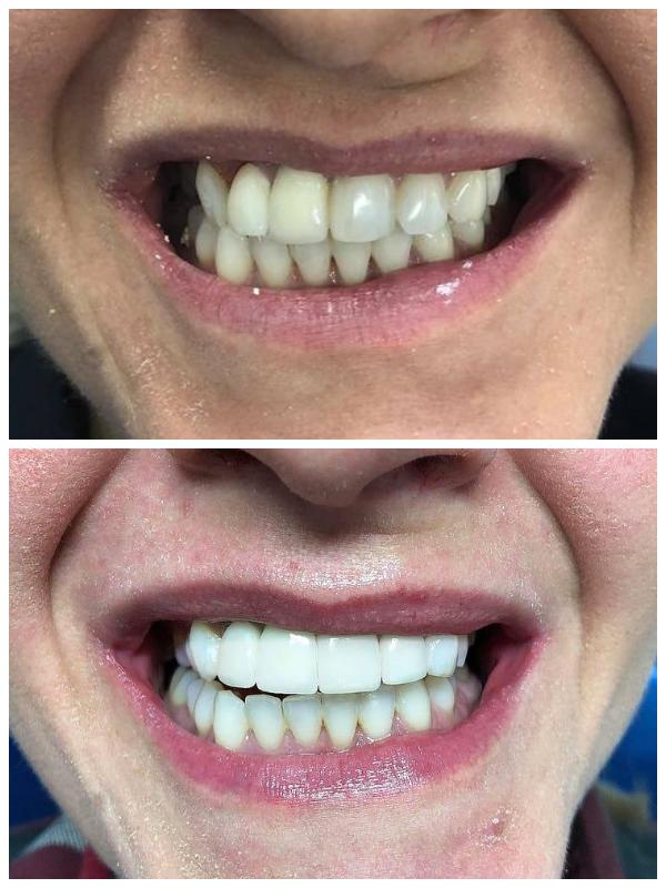 Press veneers on 21, 22. All ceramic crowns on 11,12. Shade and shape correction, face midline rehabilitation.