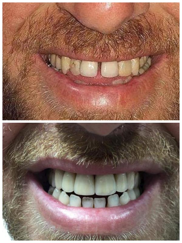 All ceramic cowns on 6 fron maxillary teeth. Aesthetic rehabilitation and arch correction. Approvable lbial aspect and incisal line taking into consideration the occlusion height