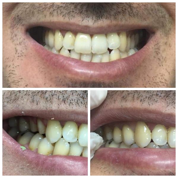 Single zirconia crowns 14,15 layered with ceramic for best chroma value outcome